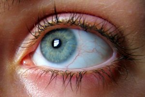 Cara Mengobati Penyakit Mata Eye Floaters