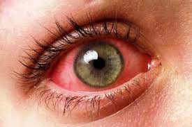 Obat Penyakit Mata Iridosiklitis Alami Dan Ampuh