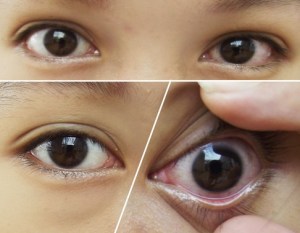 Penyebab Dan Cara Mengobati Penyakit Mata Keratitis
